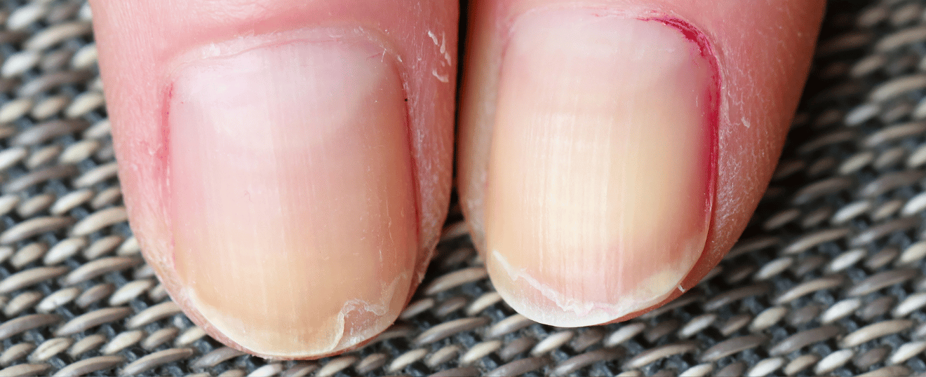 Pourquoi vos ongles se dédoublent (et comment y remédier durablement)